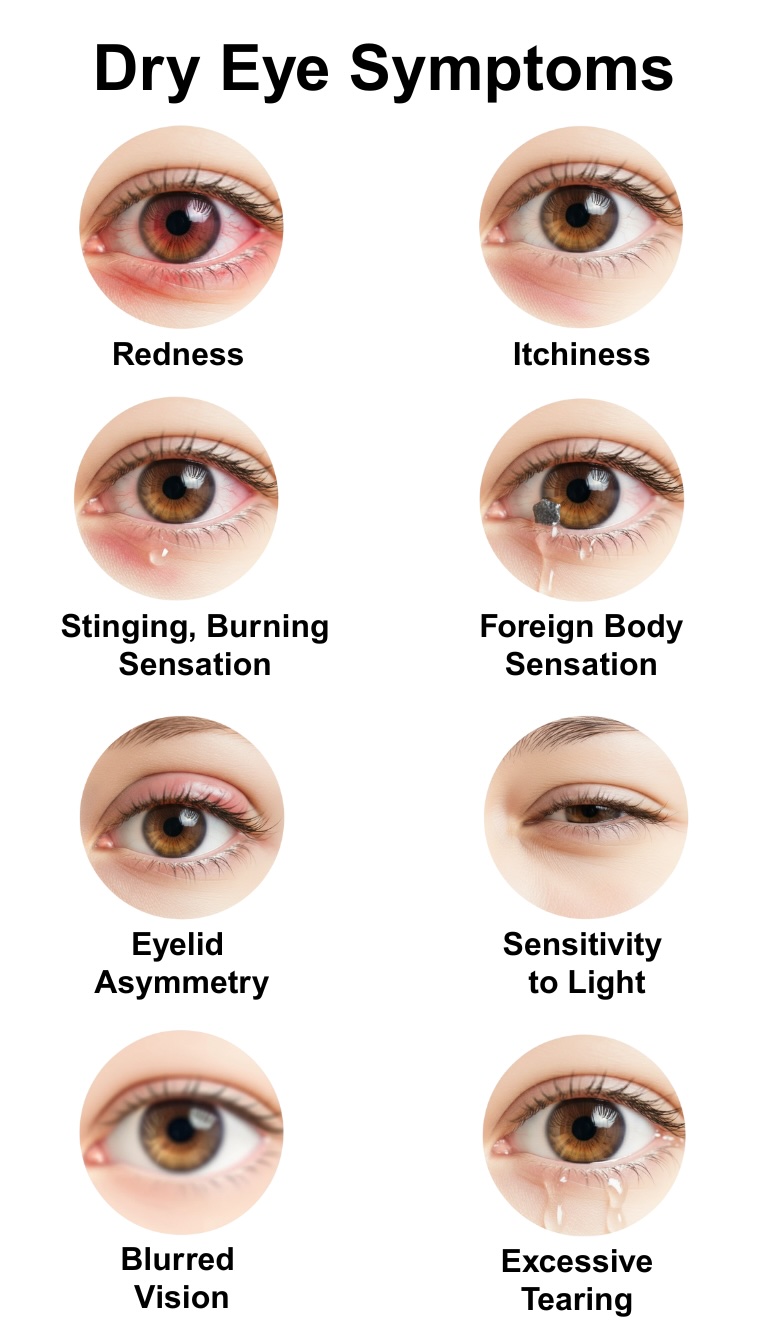 Common dry eye symptoms including burning, redness, and fluctuating vision